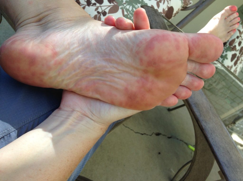 Hand Foot And Mouth Disease Vanessa Marsden RN